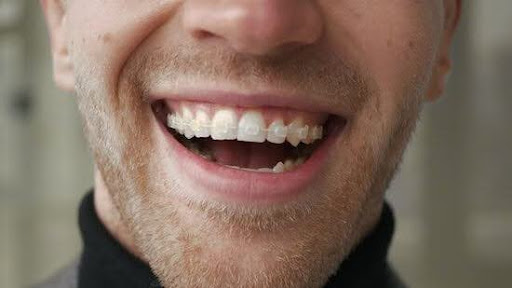 clear braces | Invisalign vs clear braces | choosing between Invisalign or clear braces