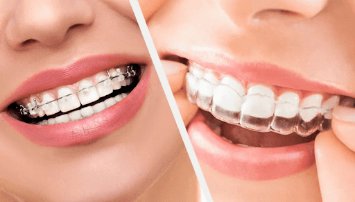 Invisalign vs clear braces | choosing between Invisalign or clear braces